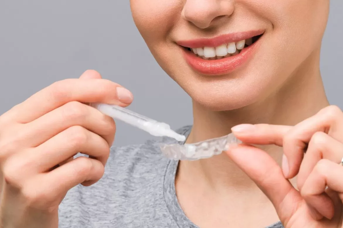 In-Office Whitening vs Take-Home Kits